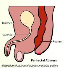 peri and perirectal abscess fistula