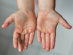 You can soothe this kin by learning effective tips here. Hand Foot And Mouth Disease Children Raising Children Network