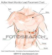 Holter Heart Monitor Lead Placement Chart Clipart K8974113