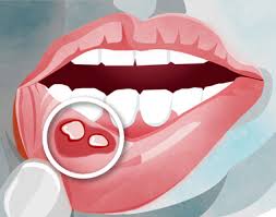 canker sores naturally