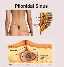 It usually takes 6 to 8 treatments and 4 to 6 weeks apart to eliminate 85% of the hairs and the hair. Pilonidal Sinus Lhr