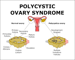 Best Diet Plans For Women With Pcos Polycystic Ovarian