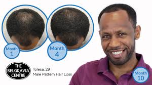belgravia male hair loss treatment