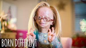 Adalia Rose: The Girl Who Ages Too Fast ...