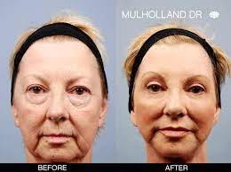 Lawrence tong can help you look younger, set up a mini facelift consultation with dr. Toronto Facelift Rhytidectomy Toronto Plastic Surgeons