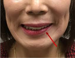 figure lower lip asymmetry after