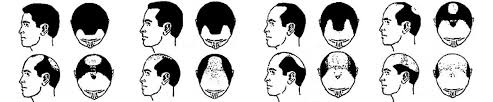 Classification Of Hair Loss In Men Bernstein Medical