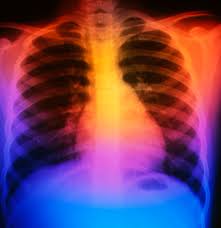 Having pain under your right rib cage very often is a cause for concern because this may be a sign of a serious medical condition. The Difference Between Bruised Broken And Fractured Ribs