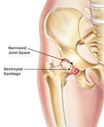 hip replacement procedure symptoms