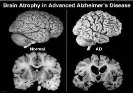 brain atrophy in advanced alzheimer s