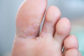 skin ling between toes causes and