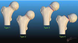 garden clification of fem neck