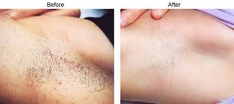 It's a vicious cycle that wastes time, energy, and ruins your confidence. Laser Hair Removal Los Angeles Hair Reduction Beverly Hills