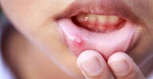 canker sores of the lips and throat