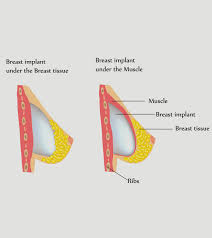 Is It Safe To Breastfeed With Implants