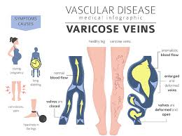 sciatica or varicose veins