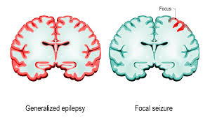 There are many different types of epileptic seizure. Epilepsy Symptoms And Causes