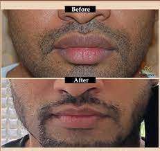 best lip augmentation lip surgery