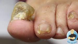 cutting painful super thick toenails