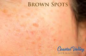 brown spots coastal valley dermatology