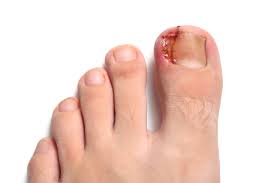 ingrown toenails blackwood podiatry