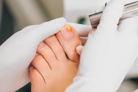 about toenail infections