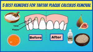 remove calculus on teeth tartar