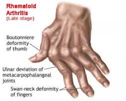 hand rheumatoid arthritis physiopedia