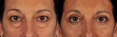 best eyelid surgery blepharoplasty