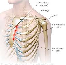 Some individuals have described it as feeling like something is squeezing their chest, while others say they experience a sharp pain under the right rib cage when breathing in. Costochondritis Chest Pain Symptoms And Treatment Patient