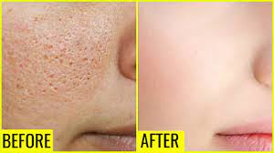get rid of large open pores permanently