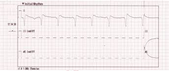 Identifying Acute Stemi In The Presence Of Paced Rhythm Jems