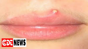 get rid of pimples on your lips