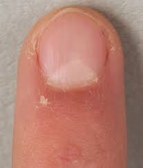 triangular lunulae in nail patella