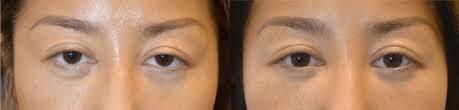 How can i get the samples9 a: What Is Eye Shape Change Dr Taban Md Beverly Hills Ca