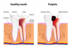 Healthy Tooth Compared To One With Dental Caries Teeth