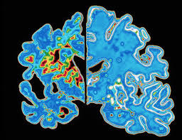 Dementia causes and risk factors. Dementia The Greatest Health Challenge Of Our Time Bbc News