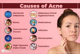 of acne without cosmetic procedures