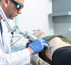 best laser tattoo removal baltimore