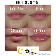 one two or four syringes filler lip