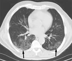Chest Ct Diffeial Diagnosis