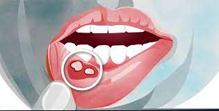 canker sores causes symptoms and
