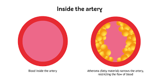 High Blood Pressure Hypertension