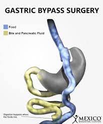 rny gastric byp surgery