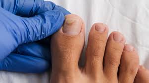 onychomycosis a look into this nail