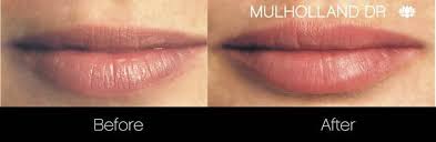 best lip injections toronto lip