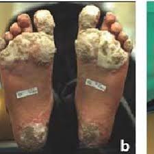 pdf plantar warts in twins after