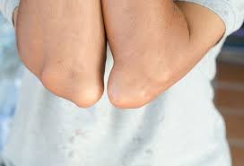 পুরুষ হোন বা মহিলা, ইউরিক অ্যাসিডের (uric acid) সমস্যা কাবু করে দেয় উভয়কেই। What Is Gout Symptoms Causes Treatment Medication Diet Remedies