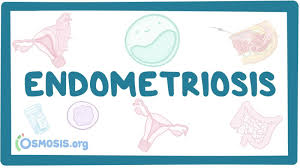 Learn about what is endometriosis and the symptoms of endometriosis explained by. Endometriosis Amboss