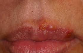 herpes treatment in philadelphia and